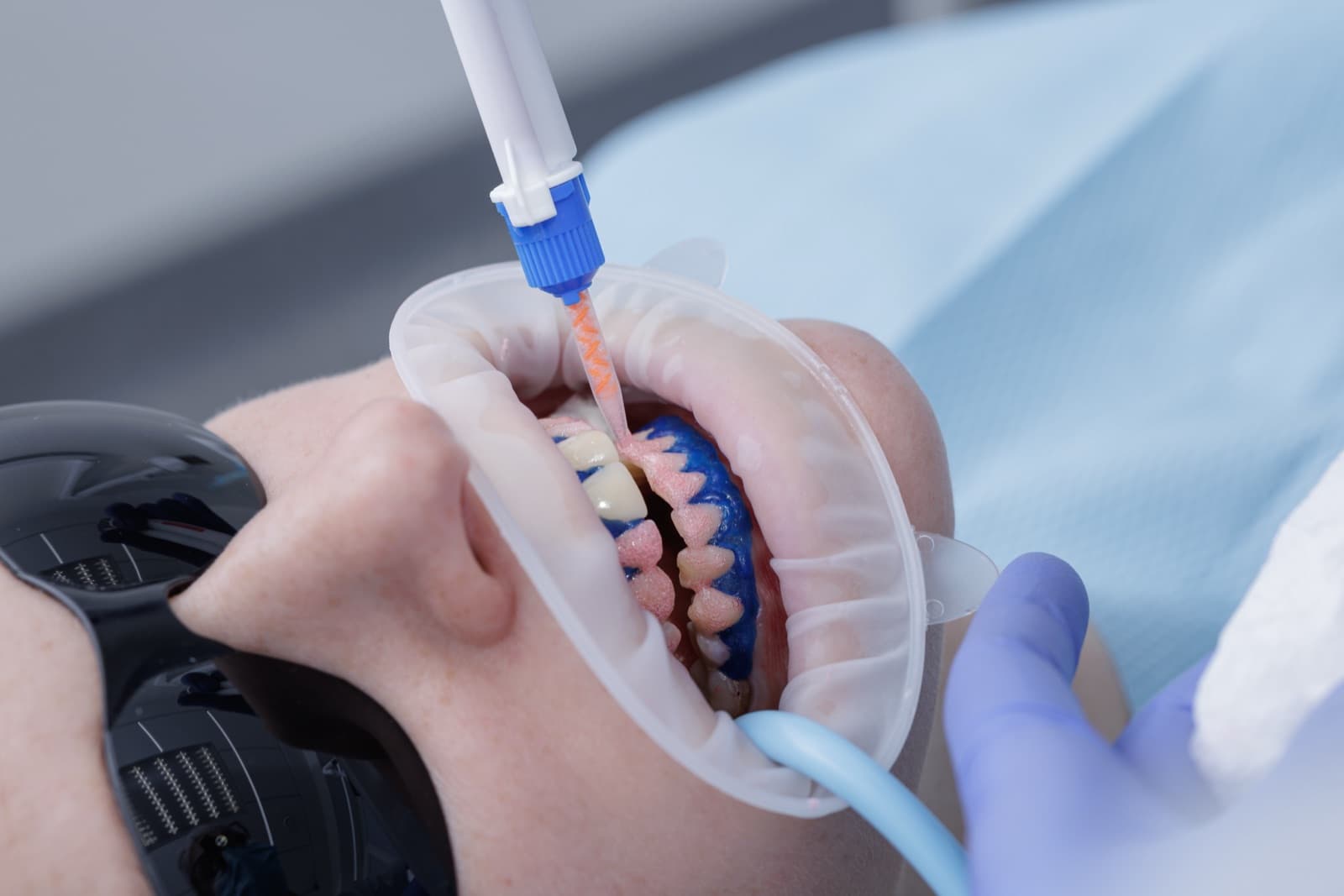 In-office whitening at the dentist